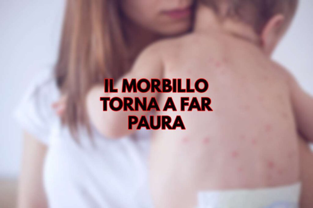 Morbillo, 1000 casi e 2 vittime negli States